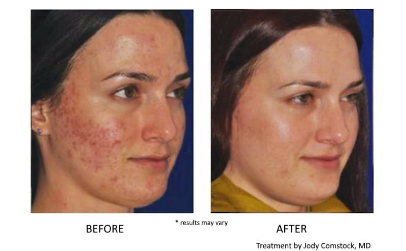 prp-facial-before-and-after-2 - Amy A. Vaughan, M.D. Dermatology