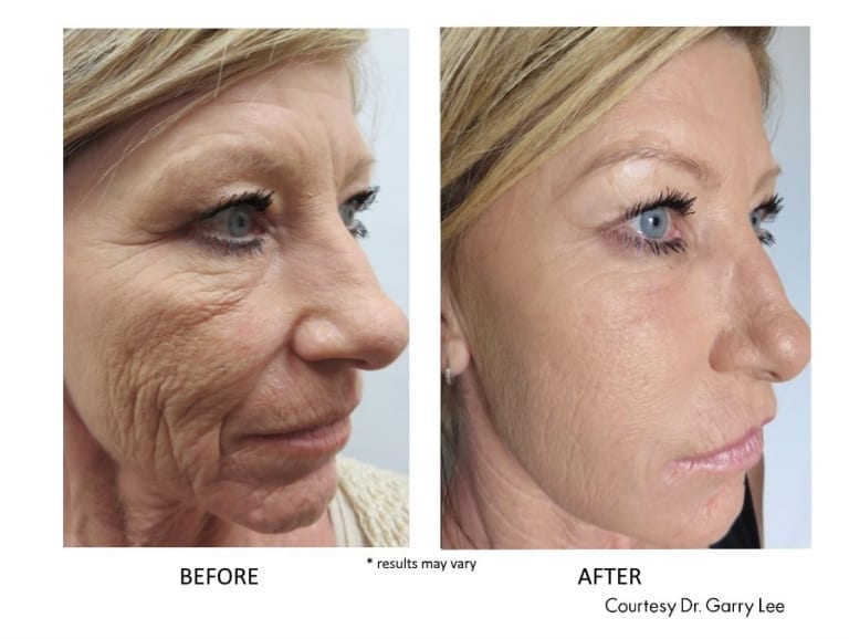 prpfacialbeforeandafterdallas3 Amy A. Vaughan, M.D. Dermatology