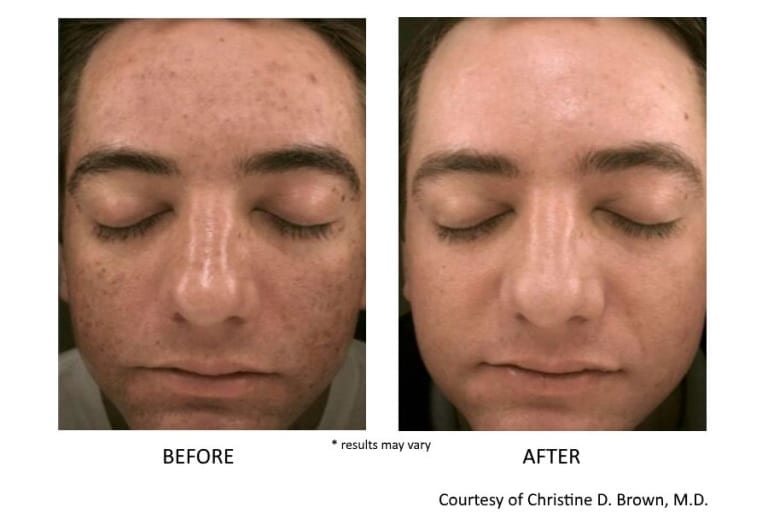 prpfacialbeforeandafterdallas Amy A. Vaughan, M.D. Dermatology