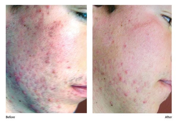 acne_001-large - Amy A. Vaughan, M.D. Dermatology